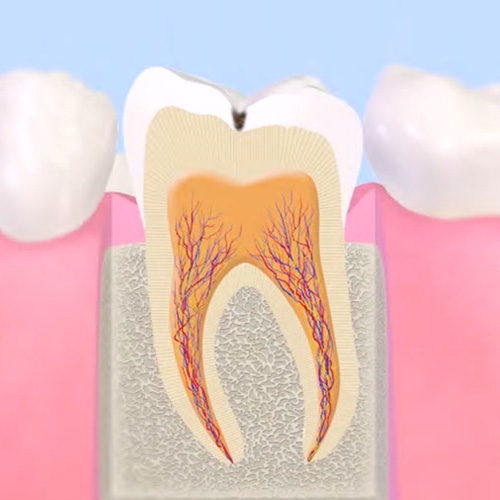 エナメル質が溶け始めた初期のむし歯(C1)の断面イラスト