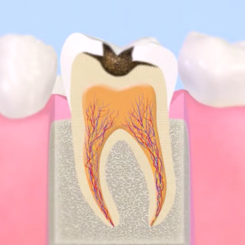 象牙質まで穴があいた進行したむし歯(C2)の断面イラスト