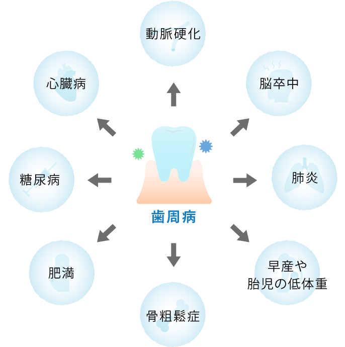 歯周病が動脈硬化・脳卒中・糖尿病など全身疾患に関わることを示す図解