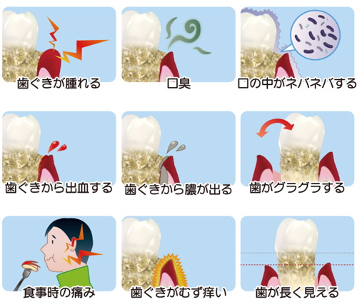 歯周病の自覚症状を9項目で示した図解