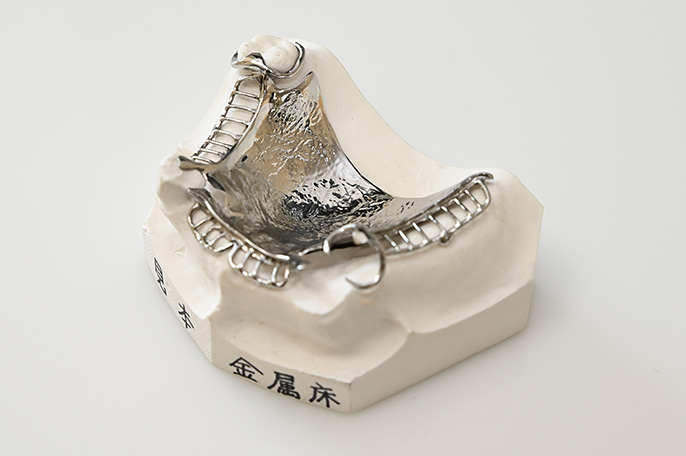 金属床義歯