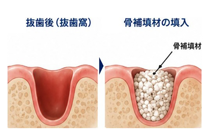 ソケットプリザベーション(抜歯窩温存術)